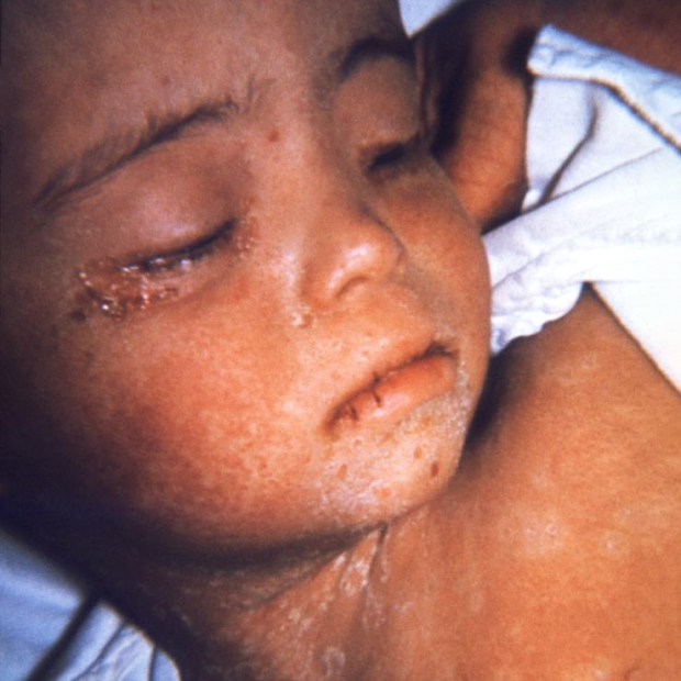 Barn med lukkede øyne og sår etter mesling-utslett og rundt øynene