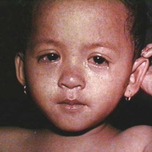 Gråtende barn med meslingutslett i ansoltet