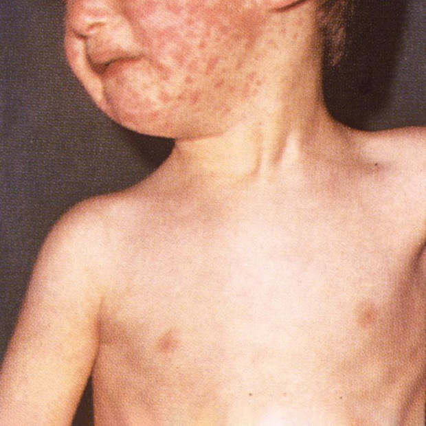 Misfornøyd barn med mesling-utslett i ansiktet